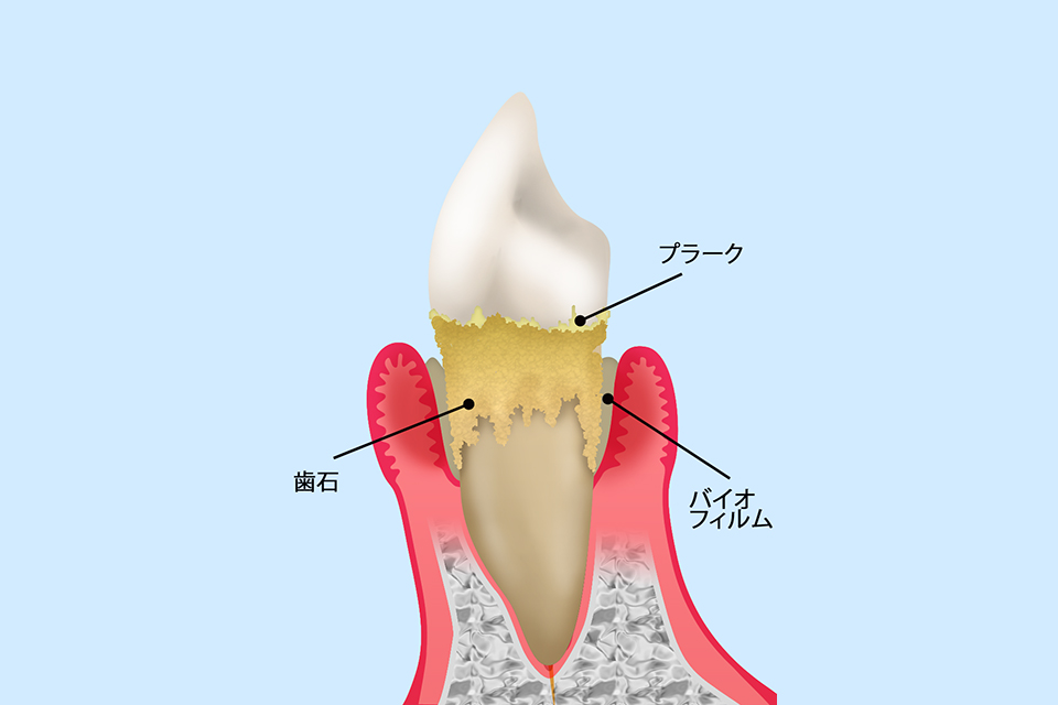 歯周病とは？