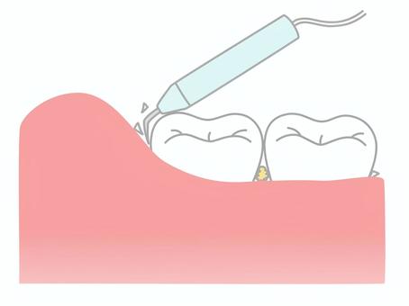 歯石取りはなんの意味があるの？？　〜メリットとデメリットについて〜5