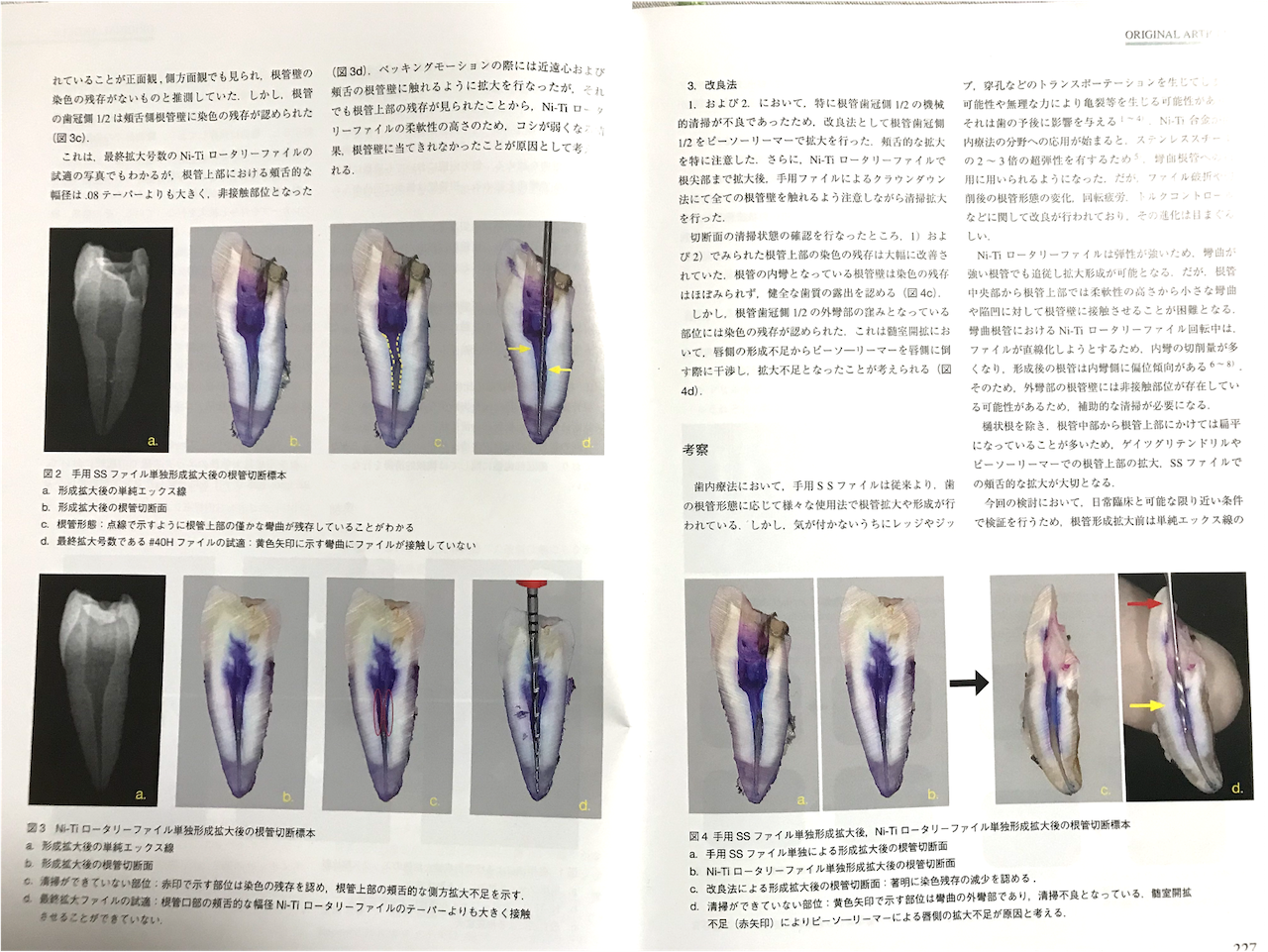 日本顎咬合学会で歯内療法に関する論文が掲載されました♪3