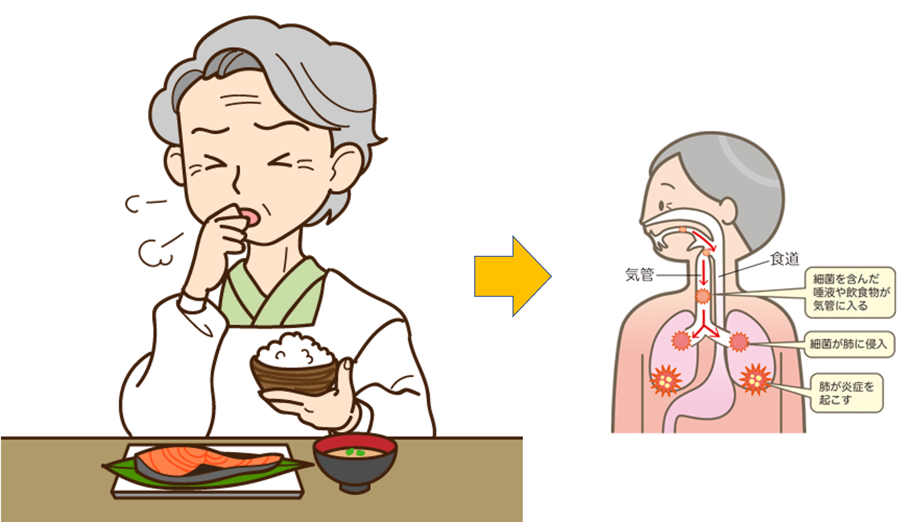 「むせ」がある方、誤嚥性肺炎を起こした方の歯科治療の注意点3