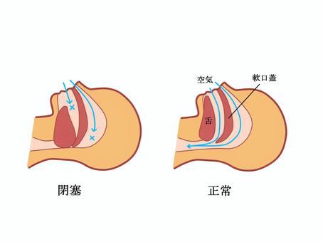 睡眠時無呼吸症候群（SAS）はマウスピース（口腔内装置：OA）で良くなるの？？3