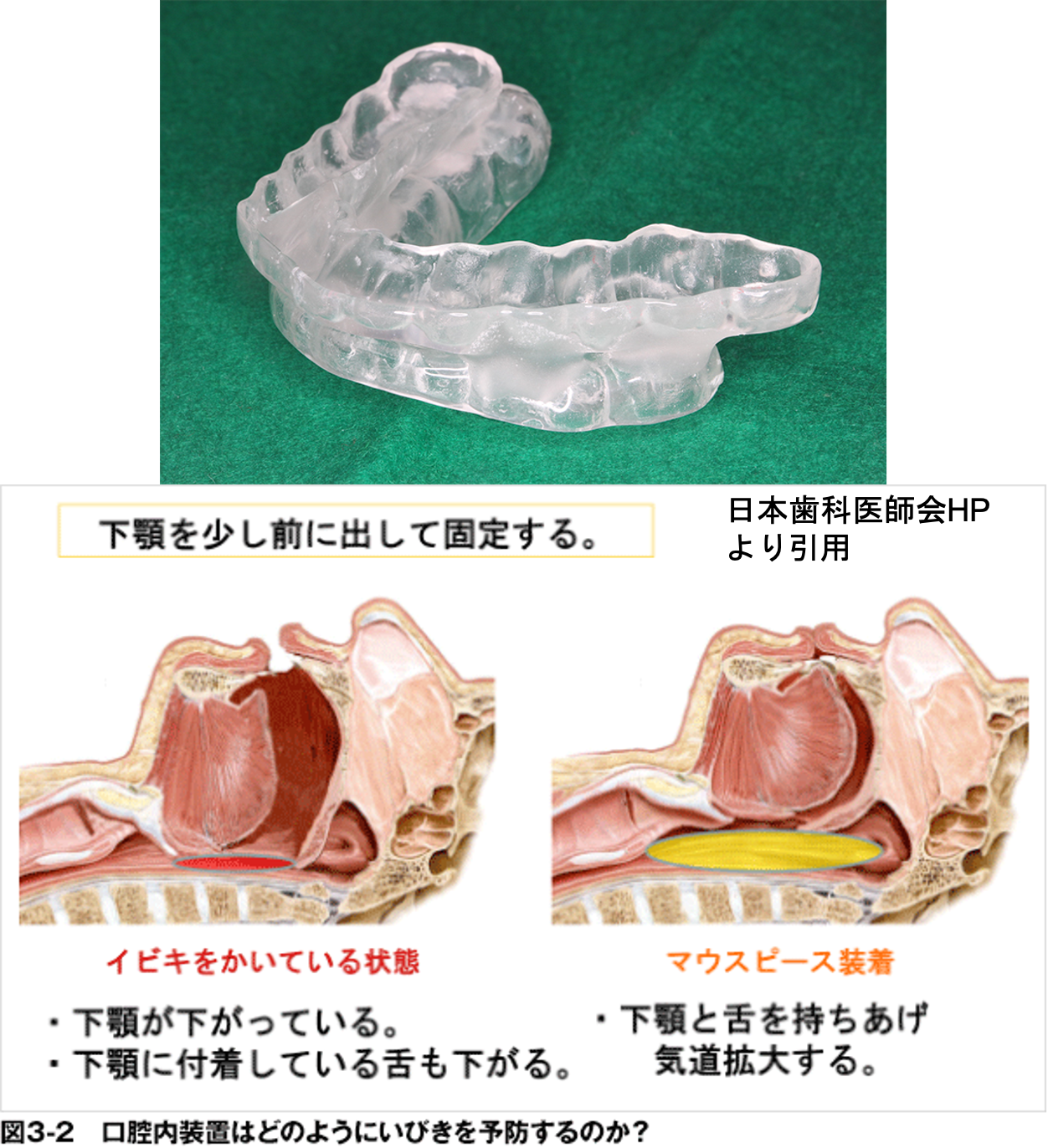 睡眠時無呼吸症候群（SAS）はマウスピース（口腔内装置：OA）で良くなるの？？6