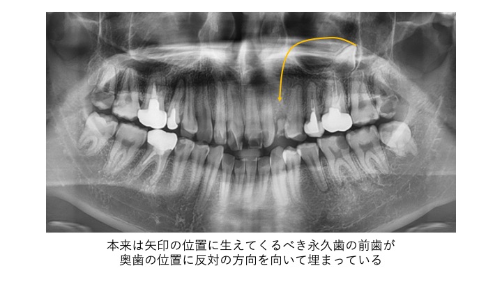 乳歯が抜けたけど、なかなか永久歯が生えてこない・・・大丈夫？？8