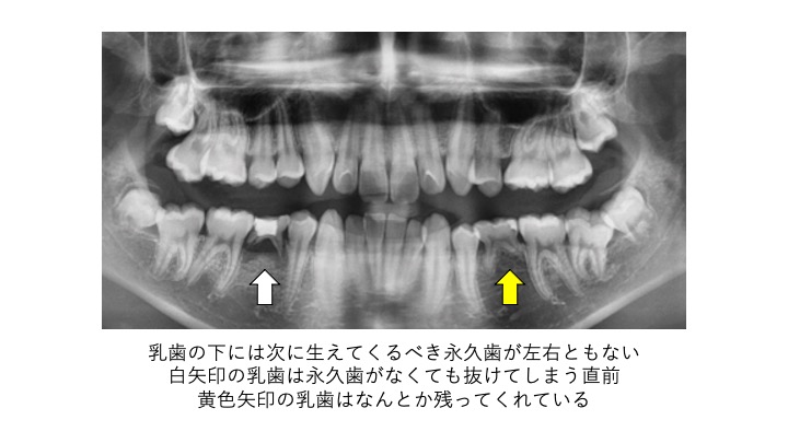 乳歯が抜けたけど、なかなか永久歯が生えてこない・・・大丈夫？？6