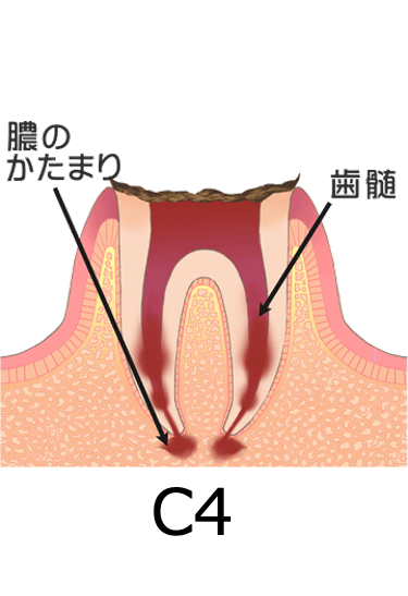 歯科健診でCO（シーオー）って言われたけどどんな意味？その後の対応は？7