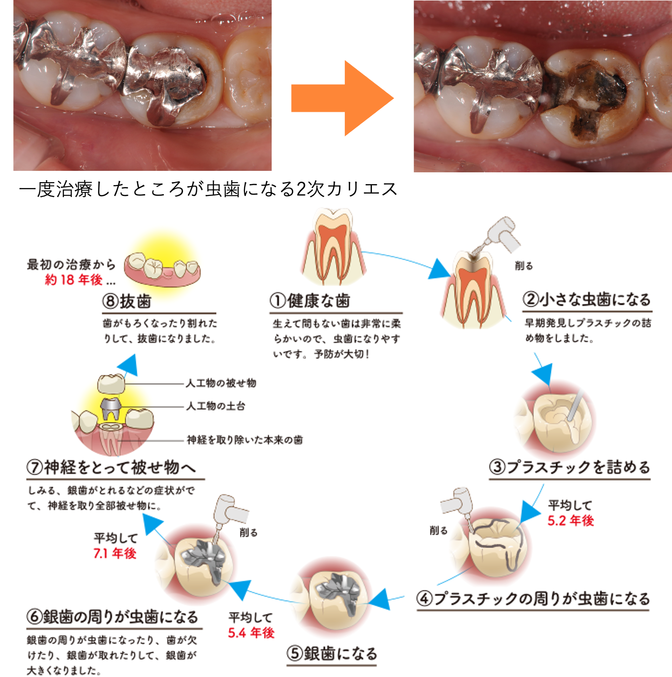 歯科健診でCO（シーオー）って言われたけどどんな意味？その後の対応は？10