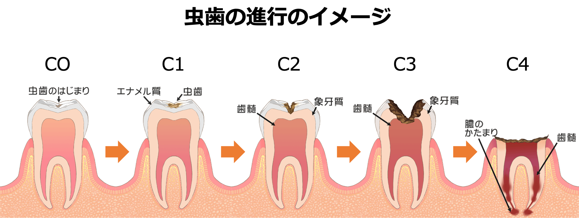 歯科健診でCO（シーオー）って言われたけどどんな意味？その後の対応は？2