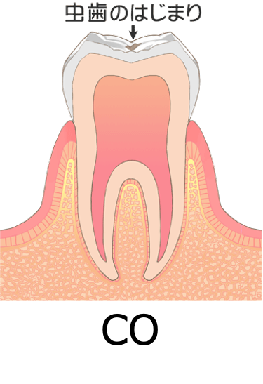 歯科健診でCO（シーオー）って言われたけどどんな意味？その後の対応は？3