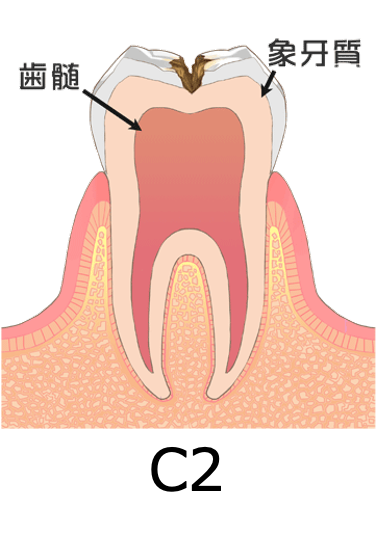 歯科健診でCO（シーオー）って言われたけどどんな意味？その後の対応は？5