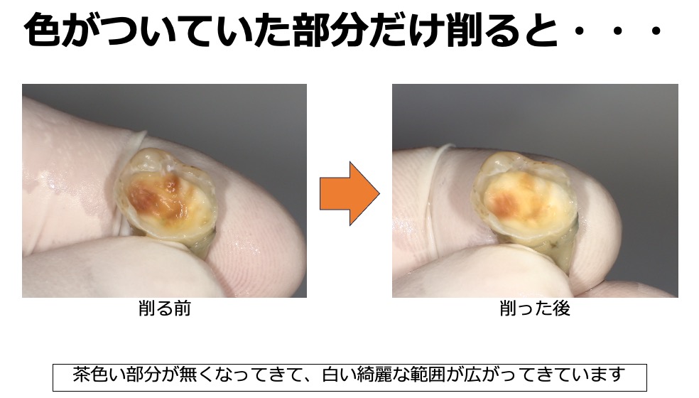 虫歯の取り残しがないようにするための、う蝕検知液を知ってますか？？7