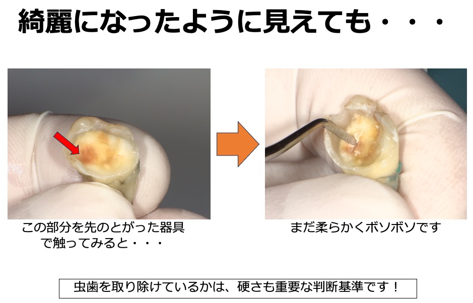 虫歯の取り残しがないようにするための、う蝕検知液を知ってますか？？8