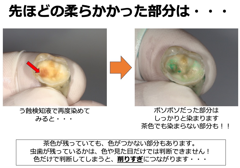 虫歯の取り残しがないようにするための、う蝕検知液を知ってますか？？9