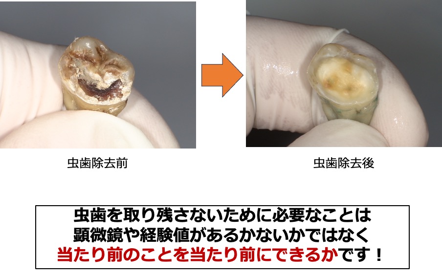 虫歯の取り残しがないようにするための、う蝕検知液を知ってますか？？10