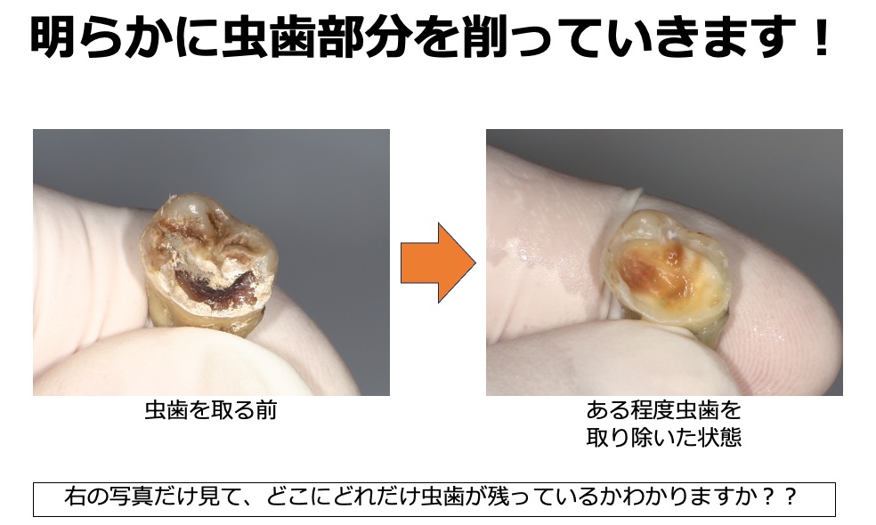 虫歯の取り残しがないようにするための、う蝕検知液を知ってますか？？5