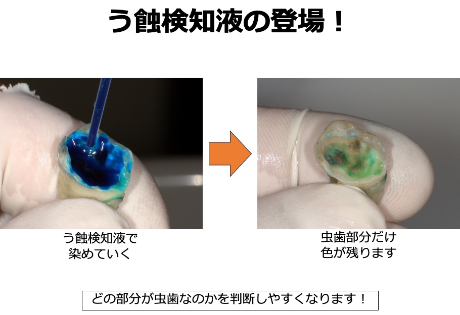 虫歯の取り残しがないようにするための、う蝕検知液を知ってますか？？6