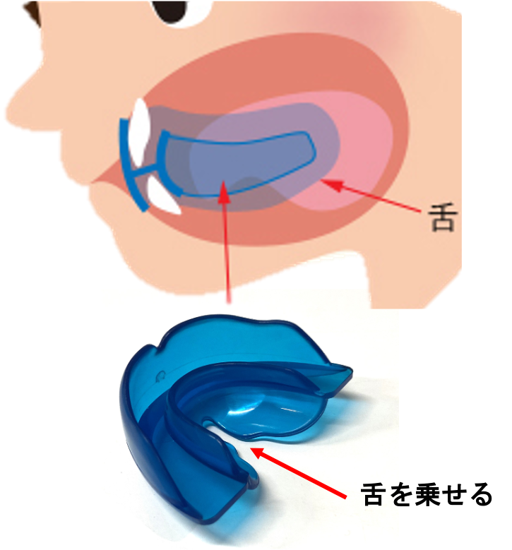 【北九州市のママ必見！】プレオルソの使い方・お手入れ完全ガイド｜たんぽぽ歯科・矯正歯科5