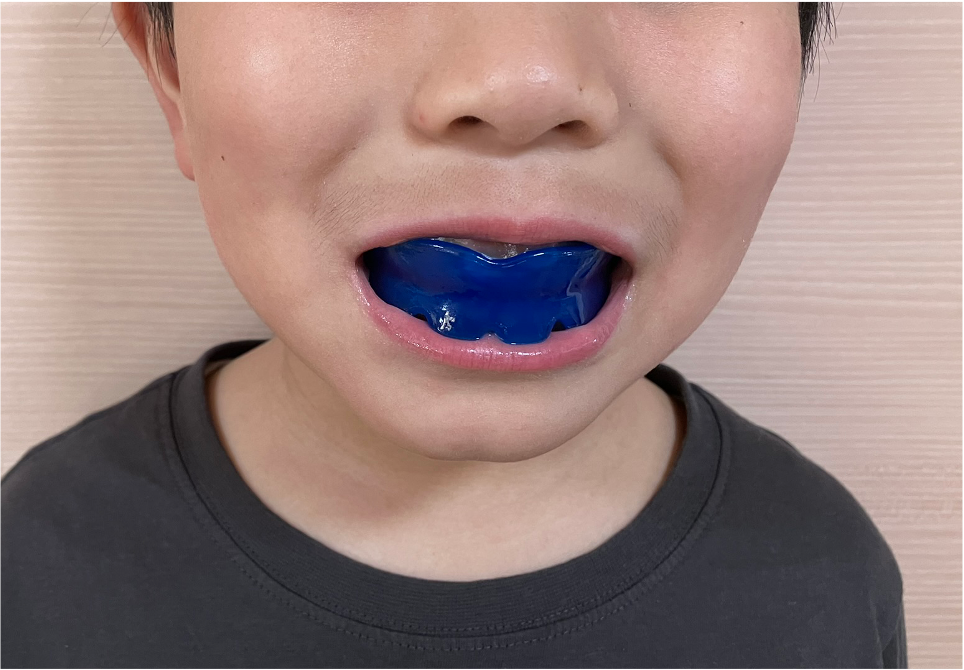 お子さんの歯並び、どのくらい装着すれば変わる？ プレオルソの疑問を小倉南区の歯医者さんが解決！4