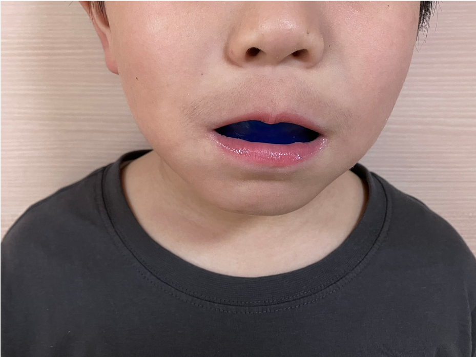 お子さんの歯並び、どのくらい装着すれば変わる？ プレオルソの疑問を小倉南区の歯医者さんが解決！5