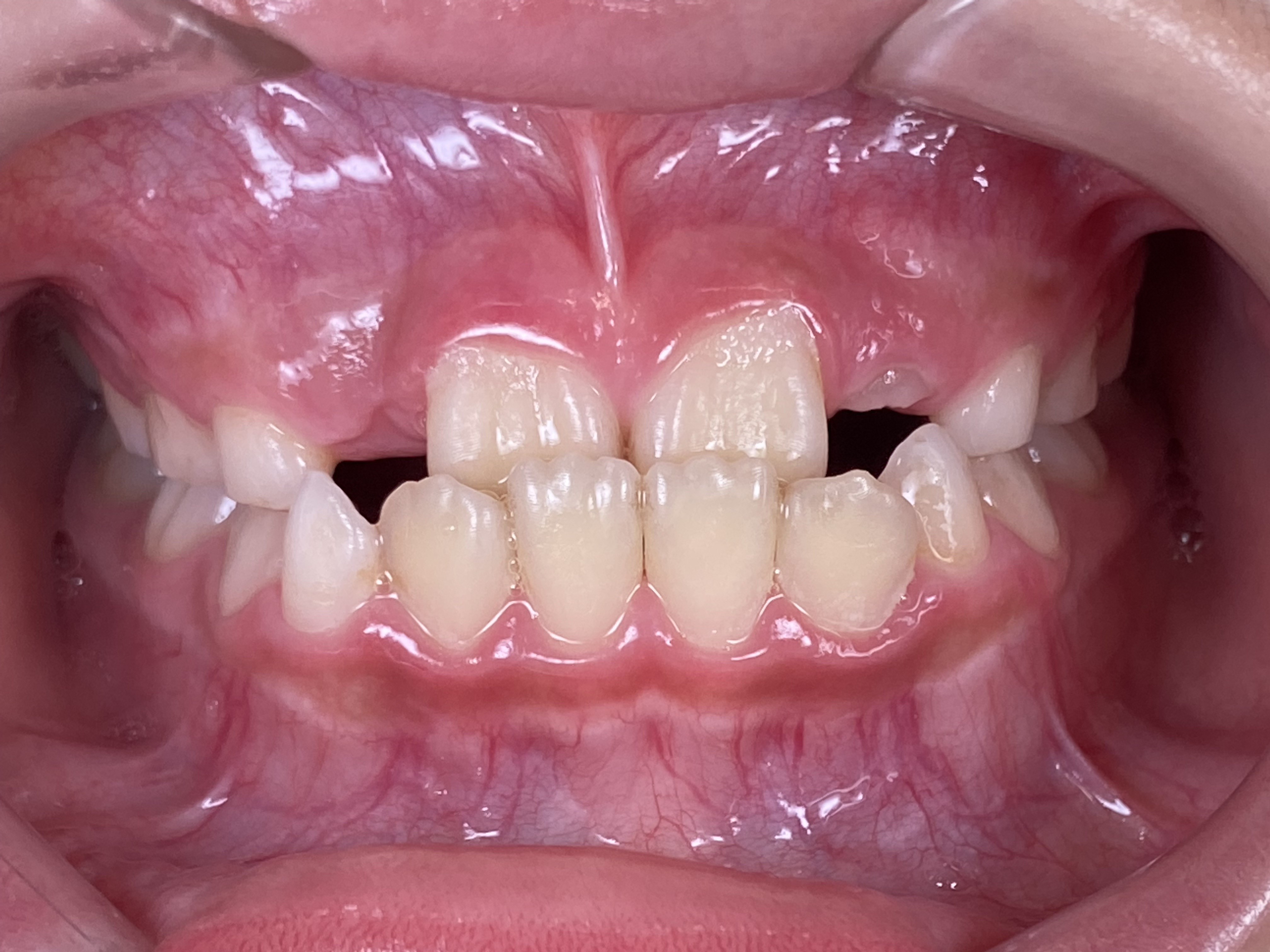 【小児矯正】子供の受け口（反対咬合）はいつから治療した方がいいの？最適な時期と当院の治療方針