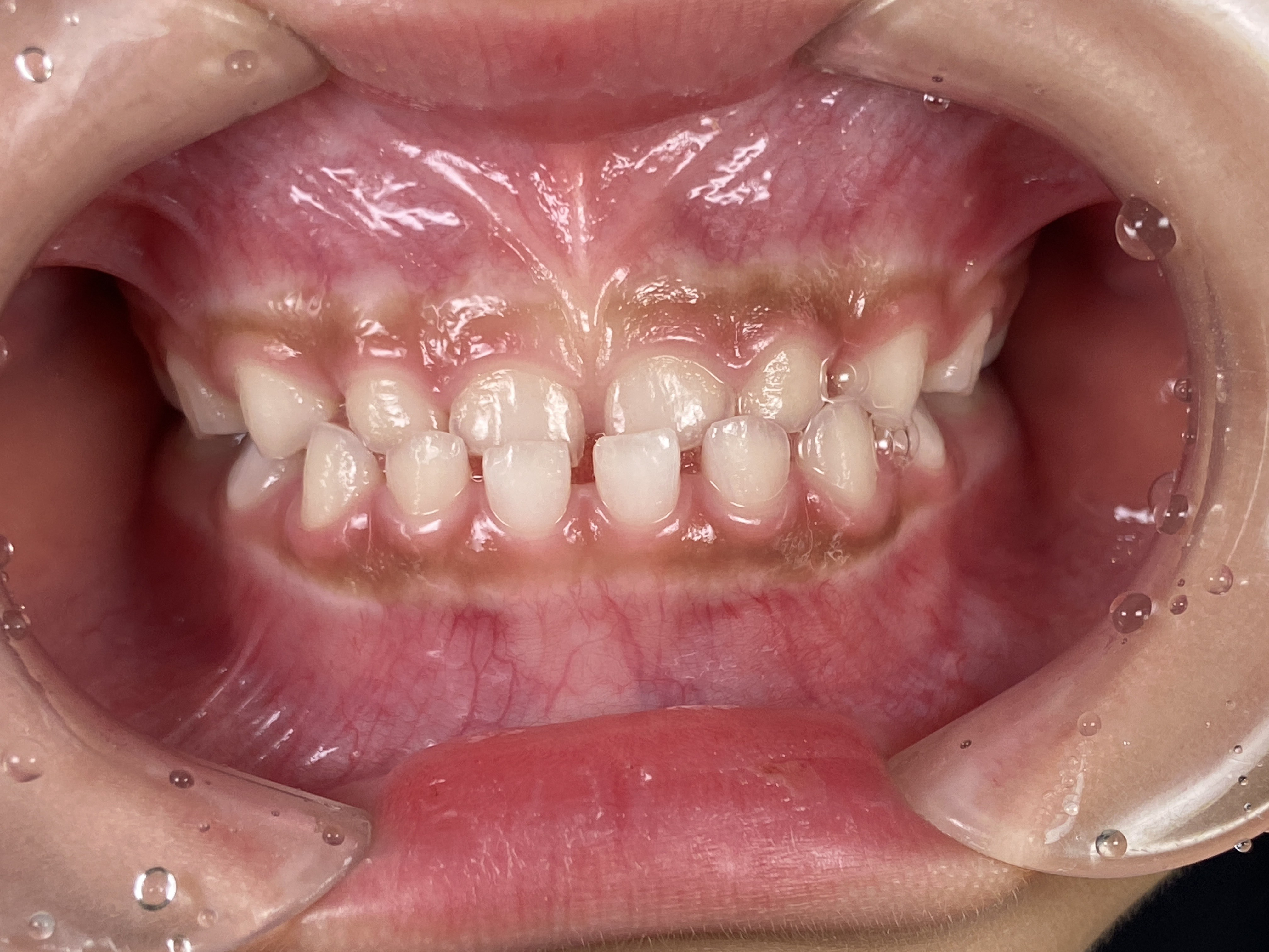 【小児矯正】子供の受け口（反対咬合）はいつから治療した方がいいの？最適な時期と当院の治療方針3