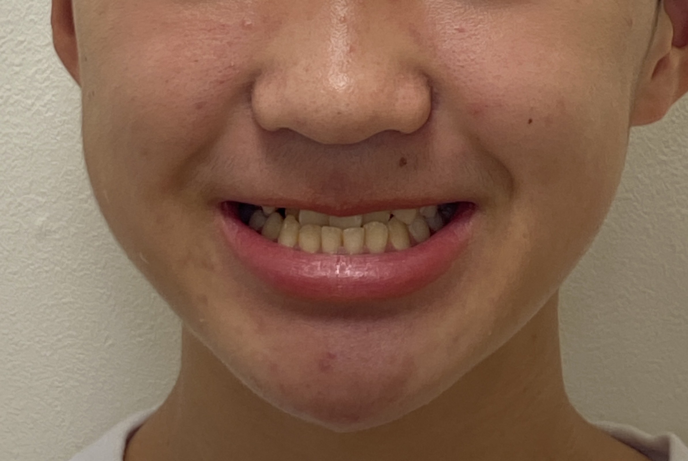 【小児矯正】子供の反対咬合(受け口)はプレオルソで治る？当院の治療実績と治らないケースの対応を解説！2