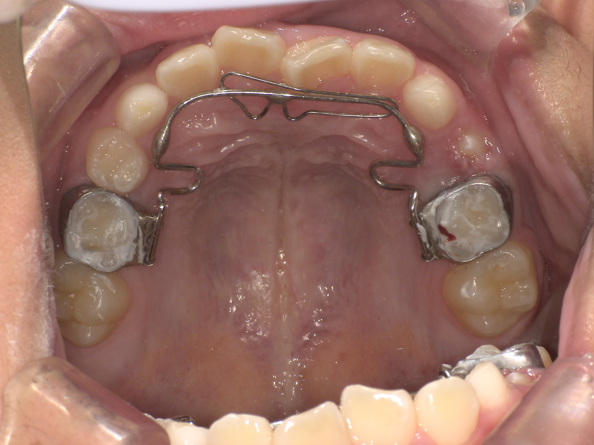 【小児矯正】子供の反対咬合(受け口)はプレオルソで治る？当院の治療実績と治らないケースの対応を解説！5