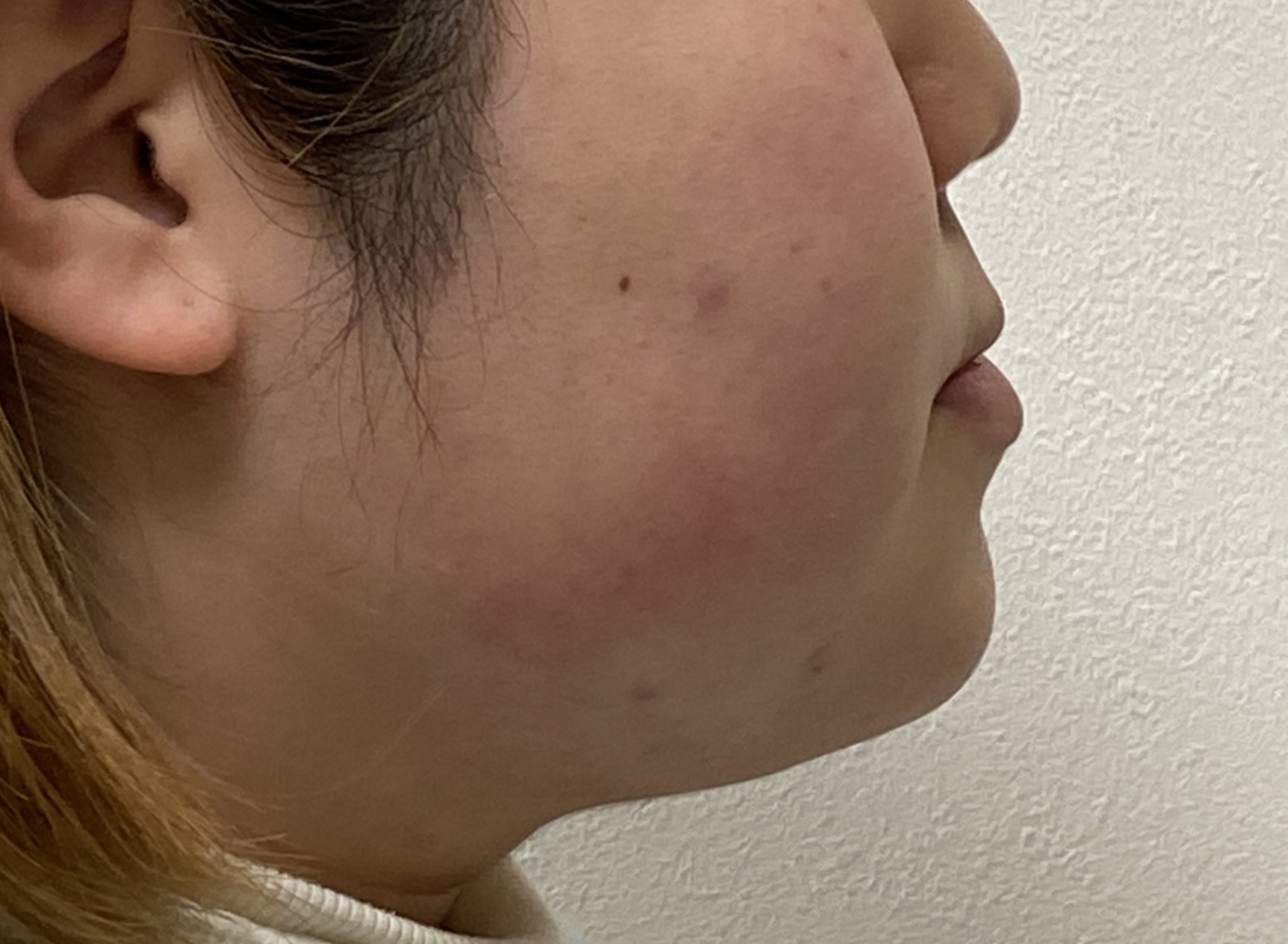 【大人の歯列矯正】受け口（反対咬合）はインビザラインで治るの？当院の治療方針と限界を解説2