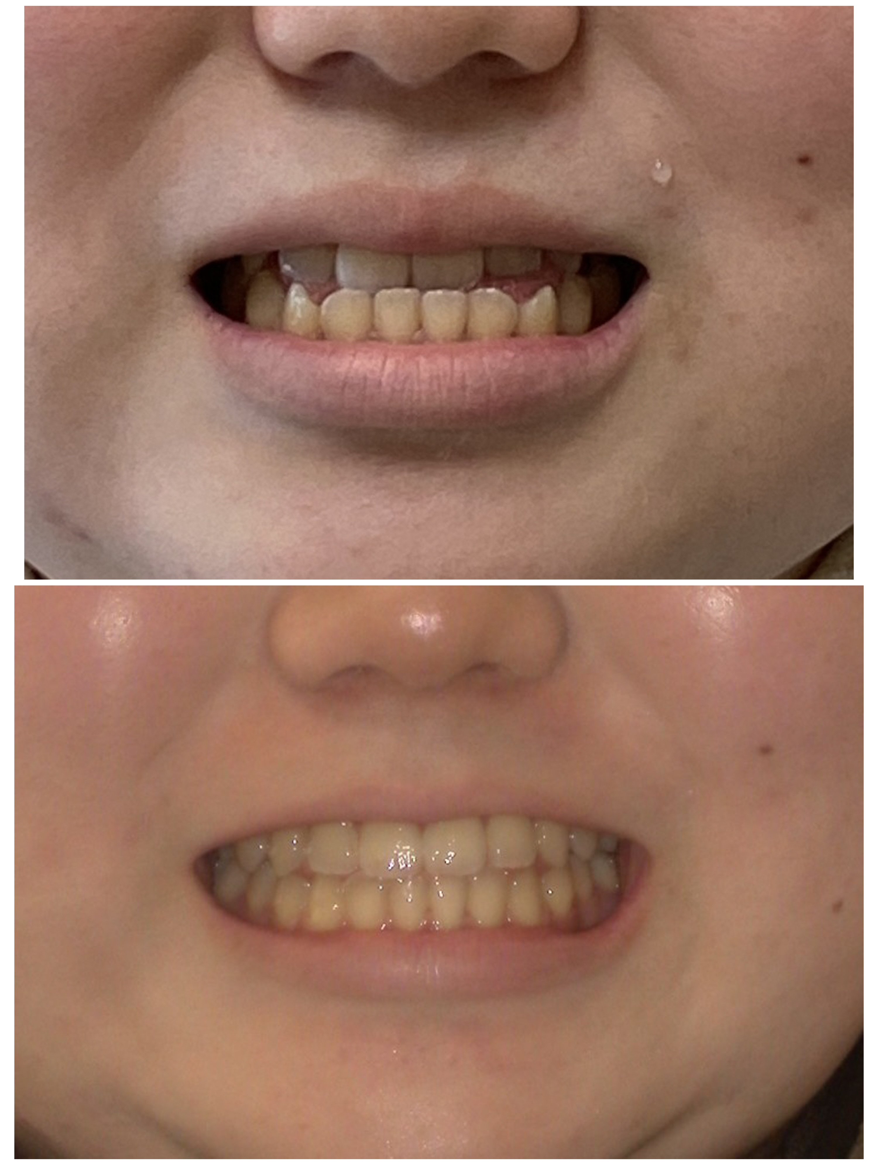 【大人の歯列矯正】受け口（反対咬合）はインビザラインで治るの？当院の治療方針と限界を解説4