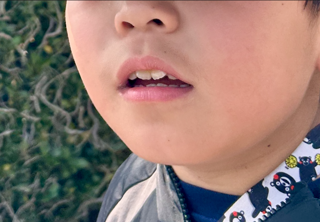 マイオブレースとは?子どもの歯並びが悪くなる原因から治療の仕組みまで北九州の親御さんへ徹底解説2