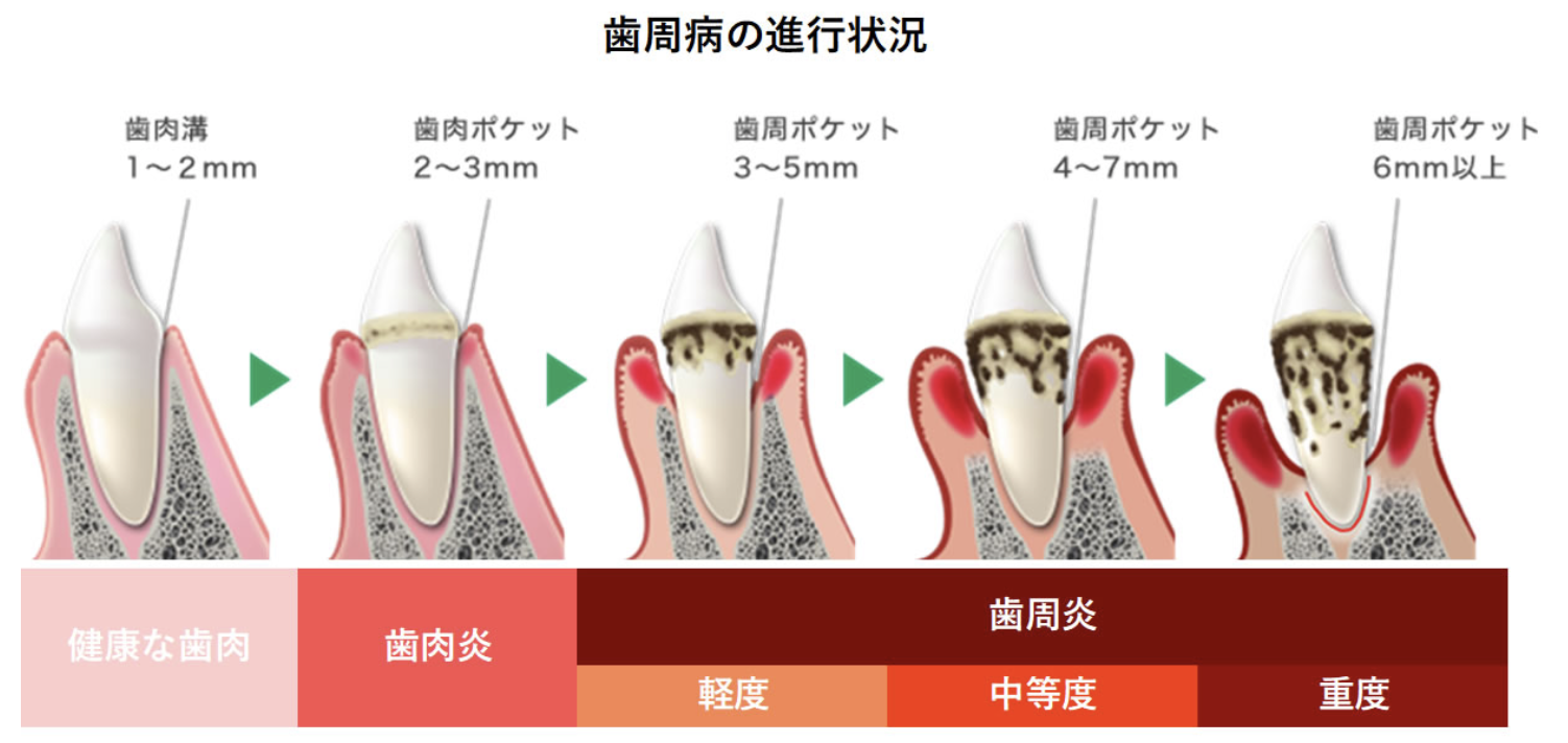 歯周病健診を受けてみませんか？4