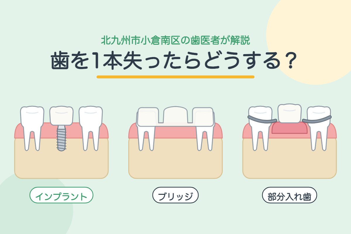 【インプラント】歯を1本失ったらどうする？インプラント・ブリッジ・入れ歯の違いを北九州市小倉南区の歯医者が徹底比較