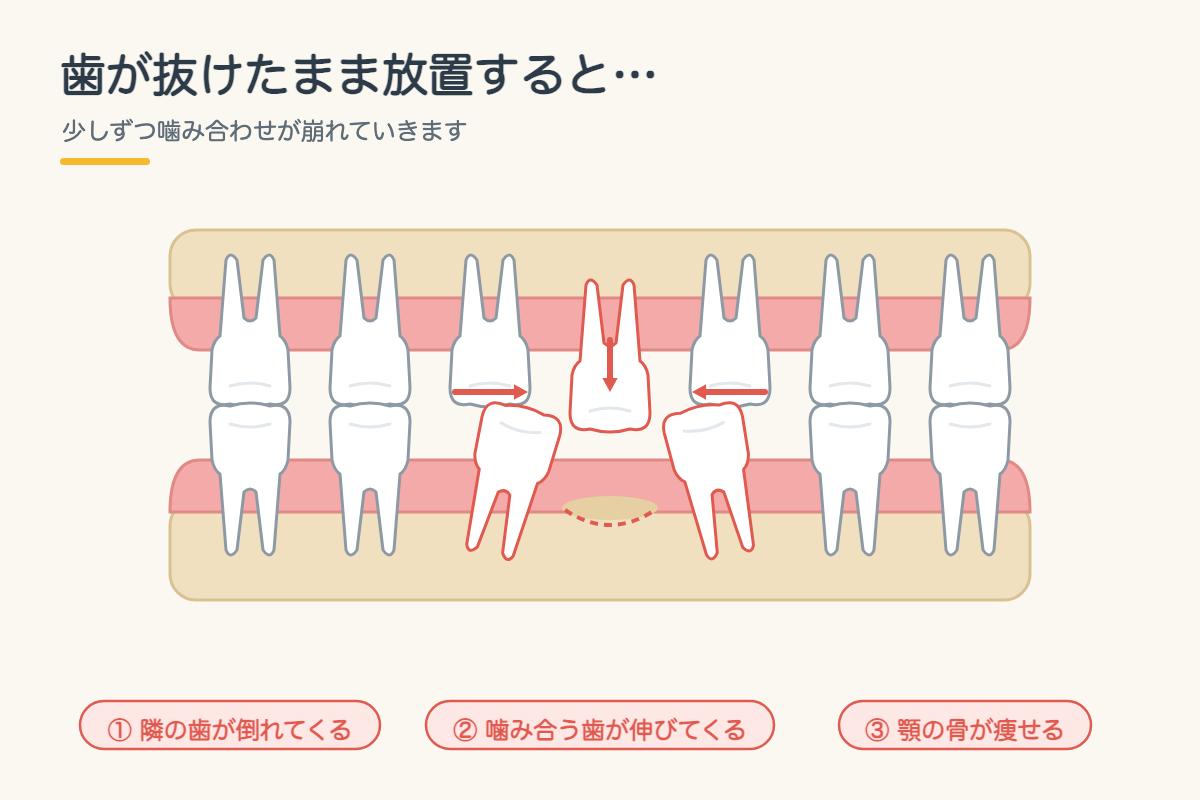 【インプラント】歯を1本失ったらどうする?インプラント・ブリッジ・入れ歯の違いを北九州市小倉南区の歯医者が徹底比較2