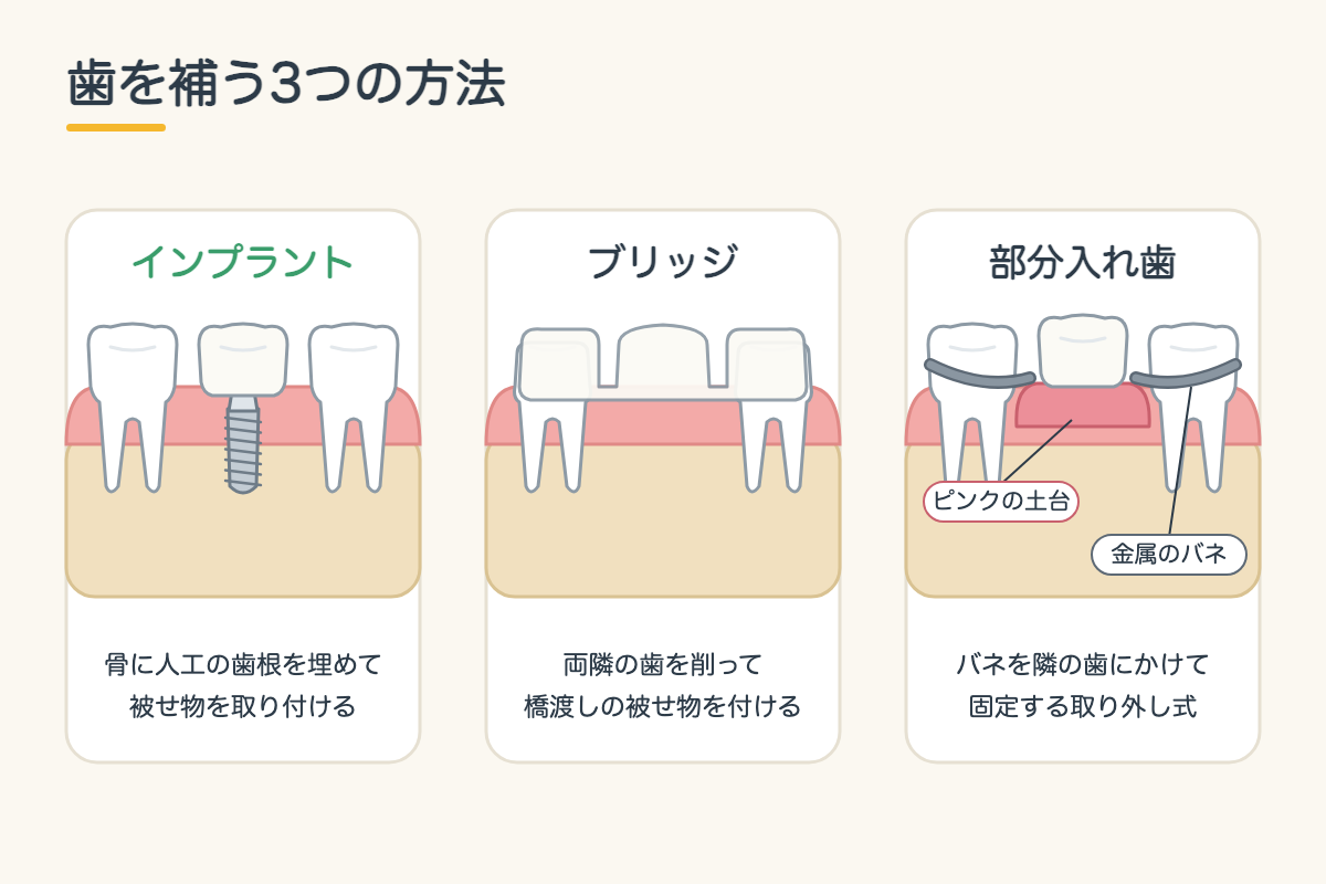 【インプラント】歯を1本失ったらどうする?インプラント・ブリッジ・入れ歯の違いを北九州市小倉南区の歯医者が徹底比較3