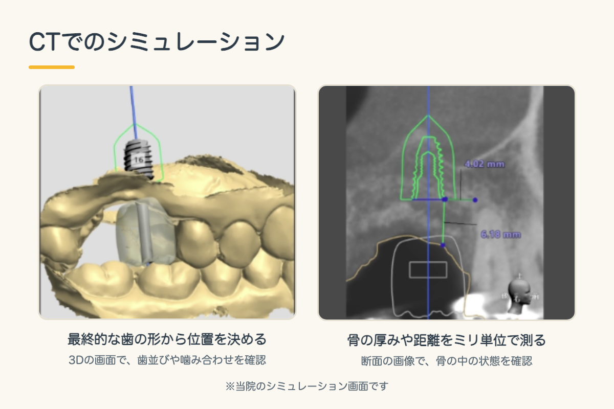 【インプラント】CTとサージカルガイドで安全性を高める手術とは?シミュレーションから埋入までを北九州市小倉南区の歯医者が解説4