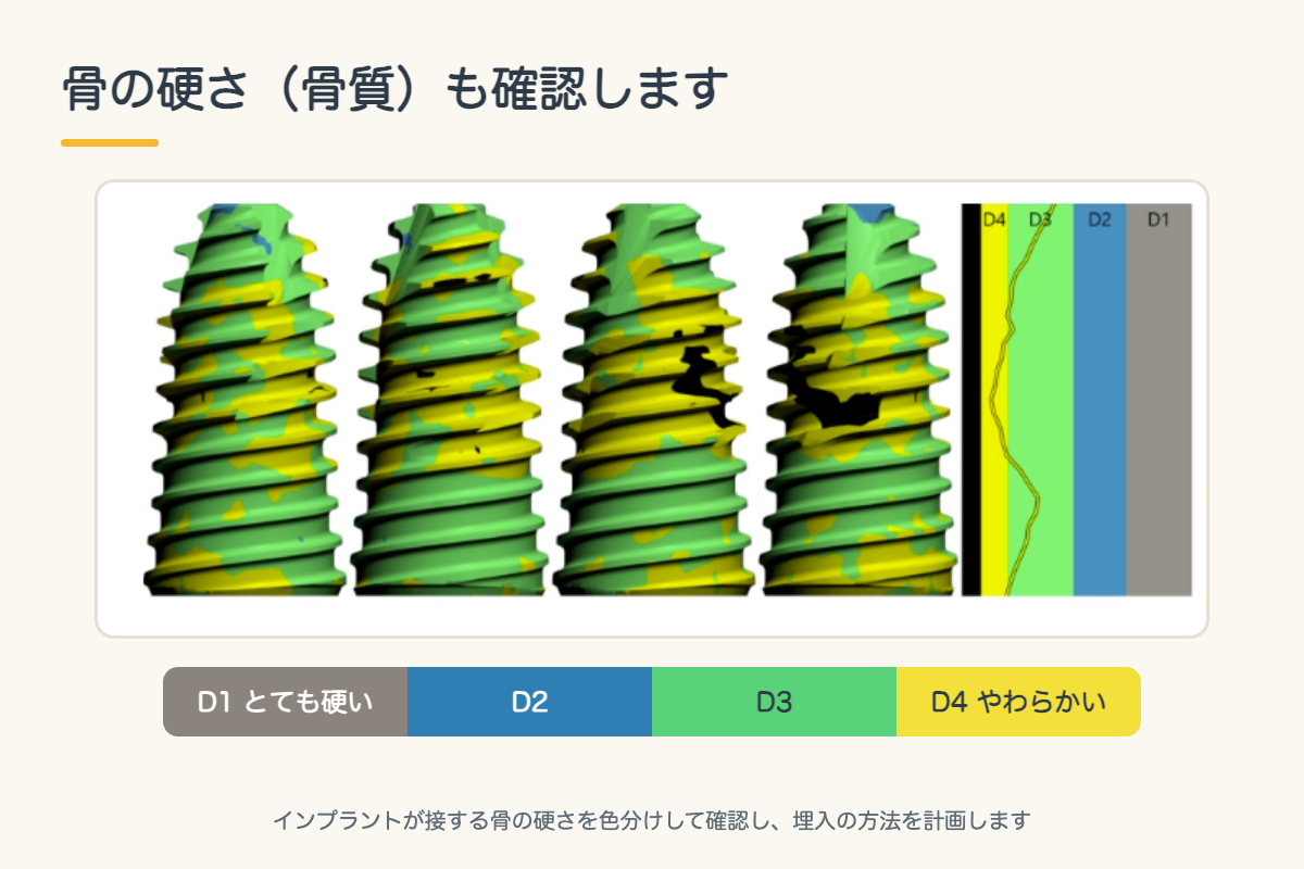【インプラント】CTとサージカルガイドで安全性を高める手術とは?シミュレーションから埋入までを北九州市小倉南区の歯医者が解説5