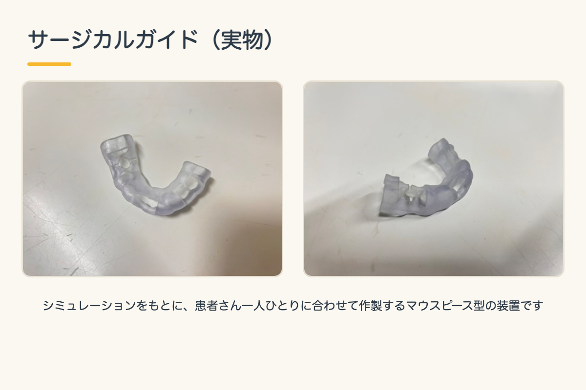 【インプラント】CTとサージカルガイドで安全性を高める手術とは?シミュレーションから埋入までを北九州市小倉南区の歯医者が解説6