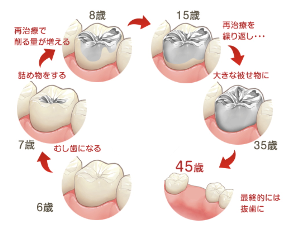 虫歯をよく繰り返してしまう？