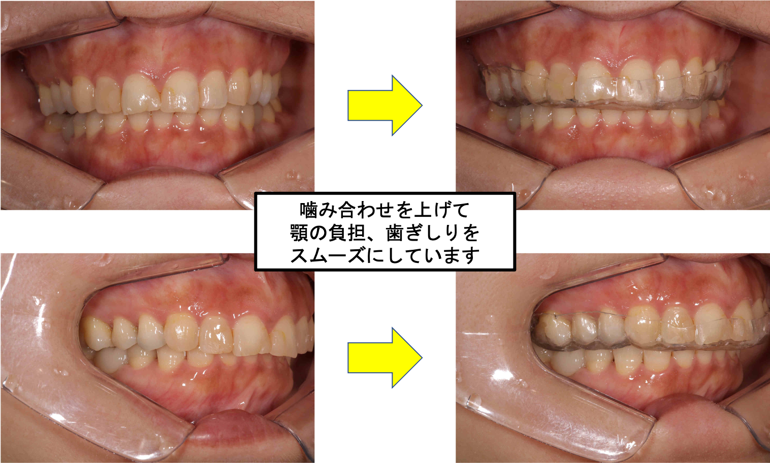 顎関節症の治療ってどうやるの？6