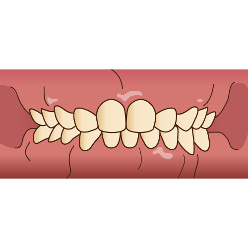 乳歯の段階で永久歯の歯並びがわかる？