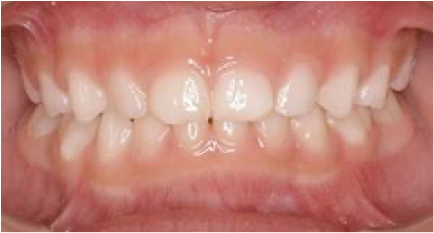 乳歯の段階で永久歯の歯並びがわかる？3