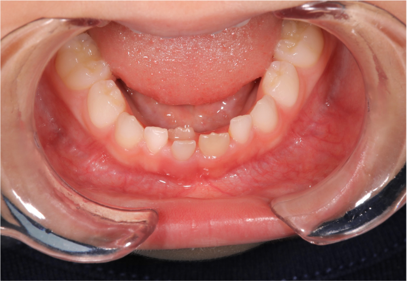 乳歯の段階で永久歯の歯並びがわかる？5