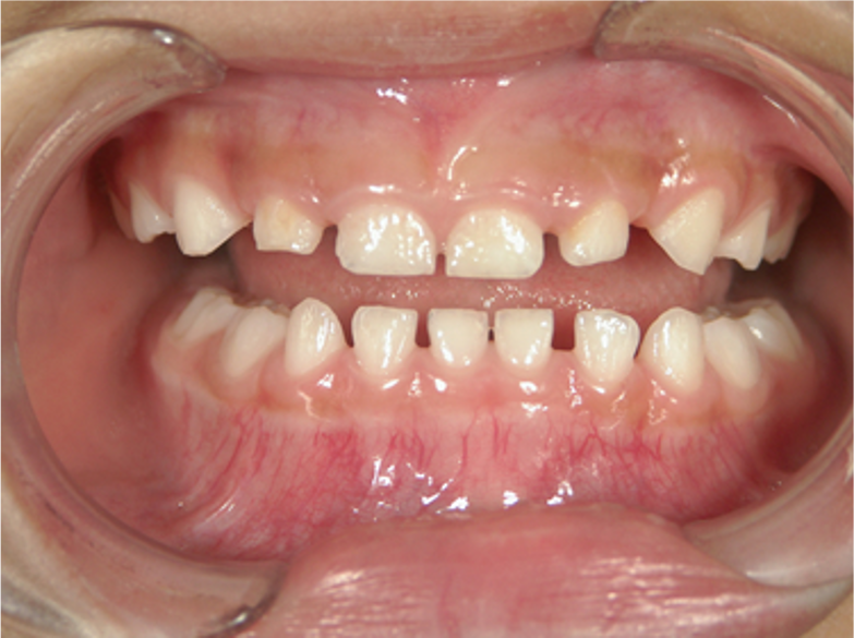 乳歯の段階で永久歯の歯並びがわかる？6