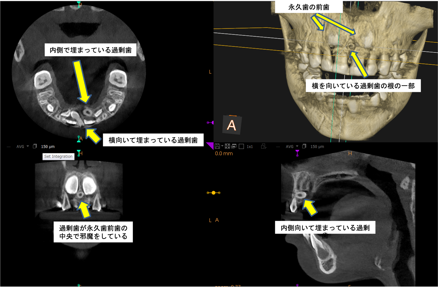 過剰歯って抜歯した方がいいの？3