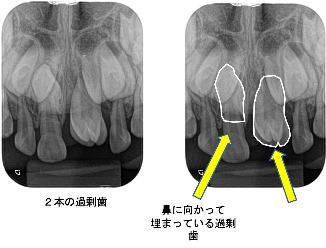 過剰歯って抜歯した方がいいの？5