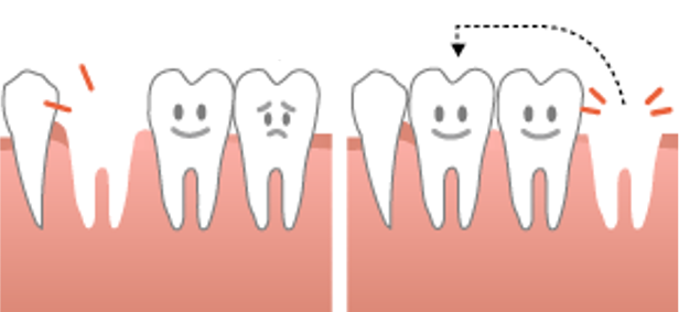 親知らずを使って歯を移植するってどういうこと？2