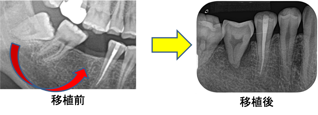 親知らずを使って歯を移植するってどういうこと？4