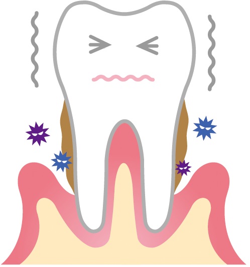 歯周病予防で認知症も予防を！4