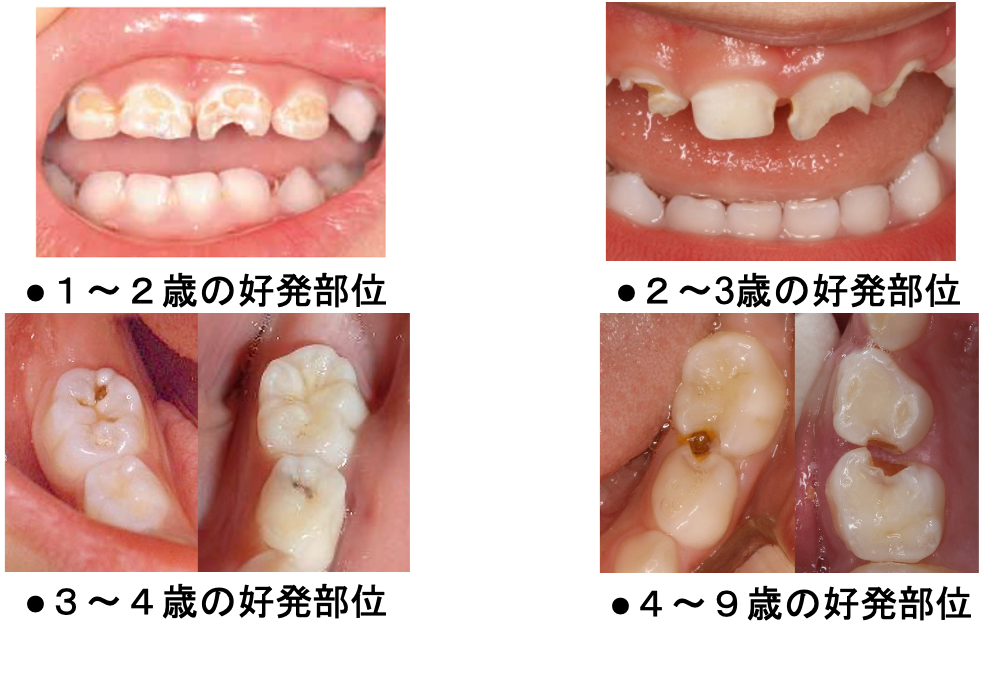 乳歯の虫歯の特徴5