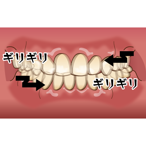 歯ぎしりしていませんか？？3