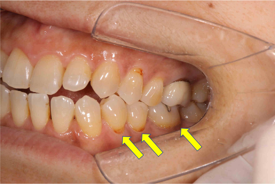 歯茎のキワに段差はありませんか？？　〜くさび状欠損（WSD）〜2